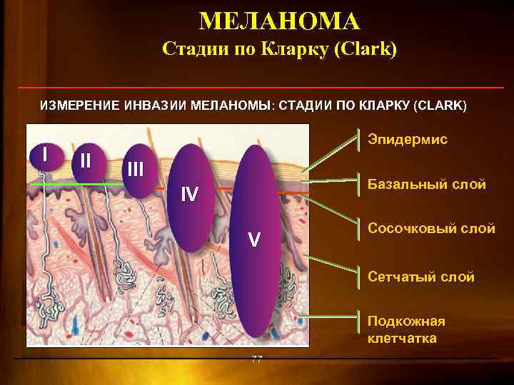 МЕЛАНОМА Стадии по Кларку (Clark) ИЗМЕРЕНИЕ ИНВАЗИИ МЕЛАНОМЫ: СТАДИИ ПО КЛАРКУ (CLARK) I Эпидермис