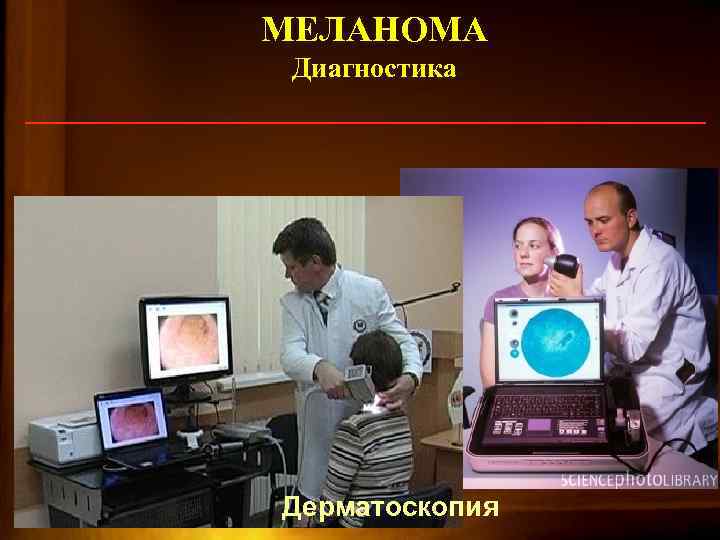 МЕЛАНОМА Диагностика 80 Дерматоскопия 