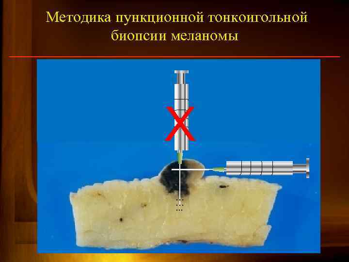 Методика пункционной тонкоигольной биопсии меланомы Х … …. . . 84 