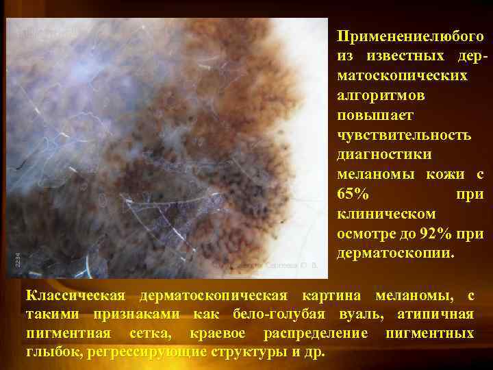 Применение любого из известных дерматоскопических алгоритмов повышает чувствительность диагностики меланомы кожи с 65% при