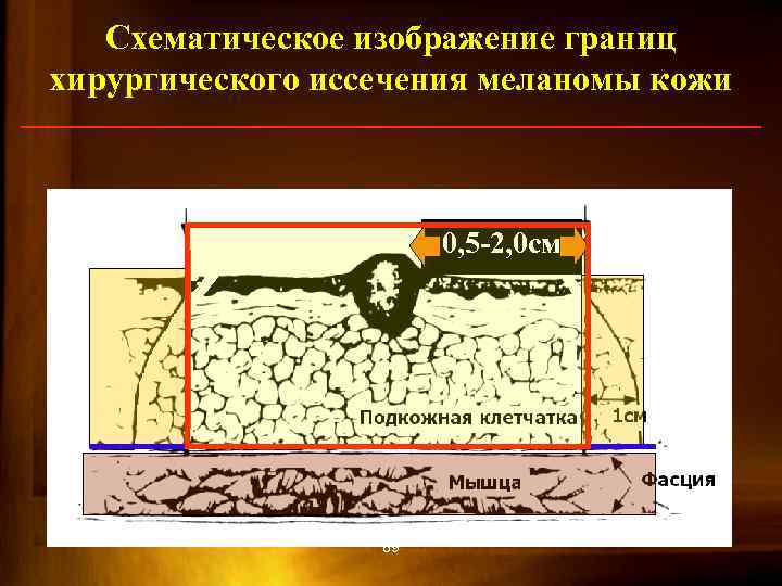 Схематическое изображение границ хирургического иссечения меланомы кожи 0, 5 -2, 0 см 89 