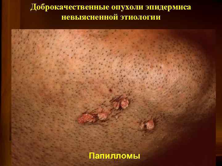 Доброкачественные опухоли эпидермиса невыясненной этиологии Папилломы 