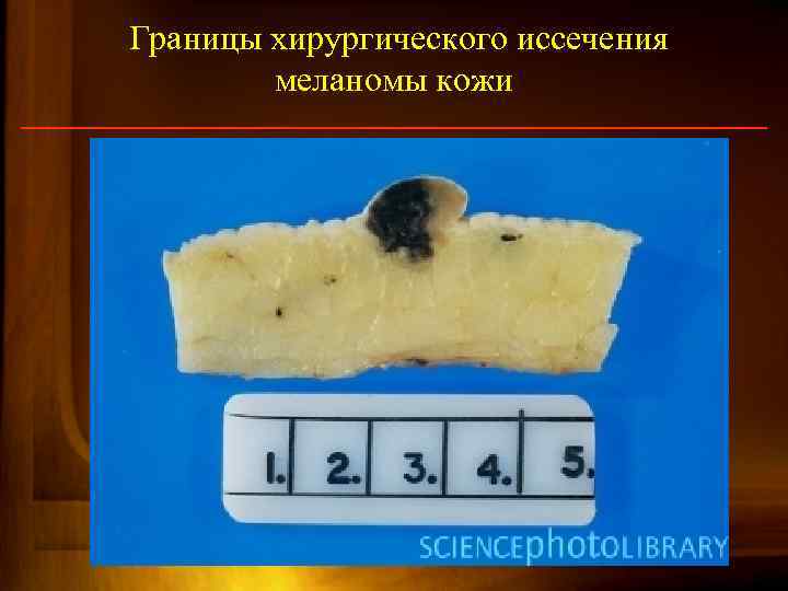 Границы хирургического иссечения меланомы кожи 90 