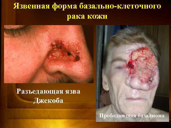 Язвенная форма базально-клеточного рака кожи Разъедающая язва Джекоба Прободающая базалиома 