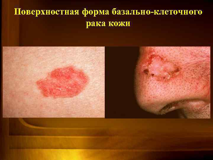 Поверхностная форма базально-клеточного рака кожи 