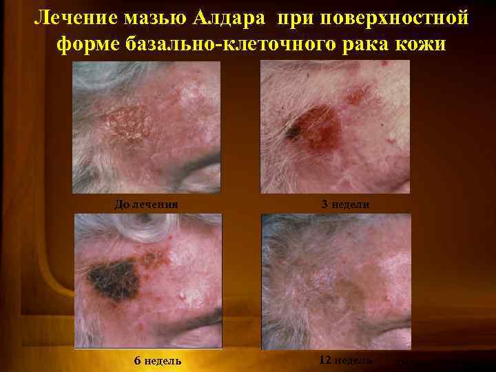 Лечение мазью Алдара при поверхностной форме базально-клеточного рака кожи До лечения 3 недели 6