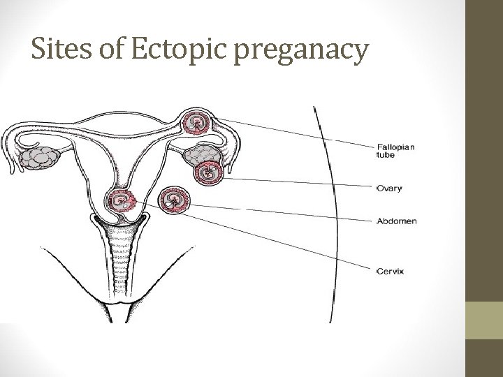 Sites of Ectopic preganacy 