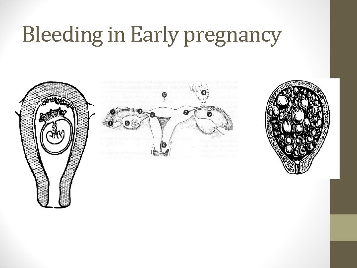 Bleeding in Early pregnancy 