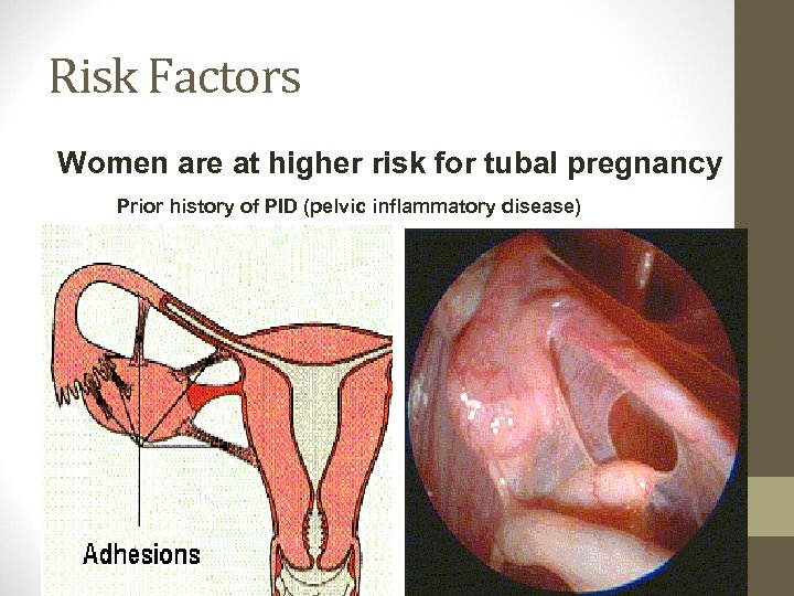 Risk Factors Women are at higher risk for tubal pregnancy Prior history of PID
