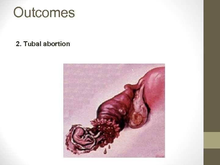 Outcomes 2. Tubal abortion 