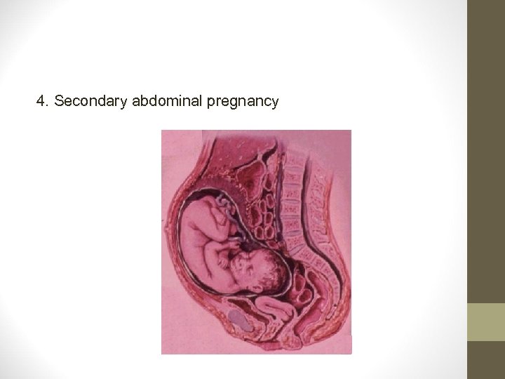 4. Secondary abdominal pregnancy 