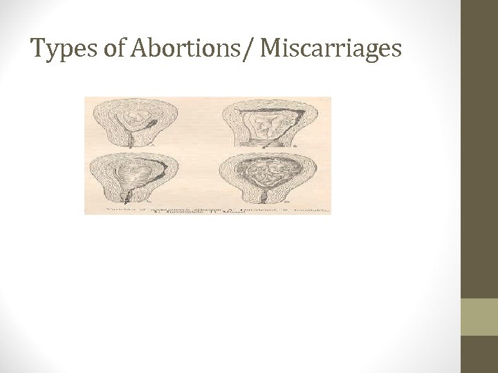 Types of Abortions/ Miscarriages 