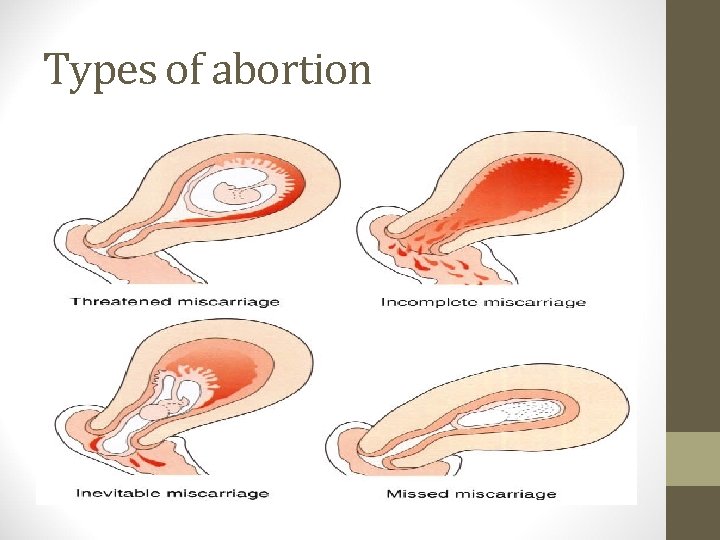 Types of abortion 