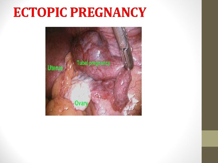 ECTOPIC PREGNANCY 