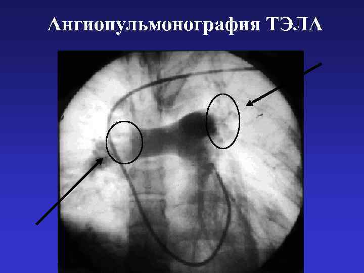 Ангиопульмонография ТЭЛА 