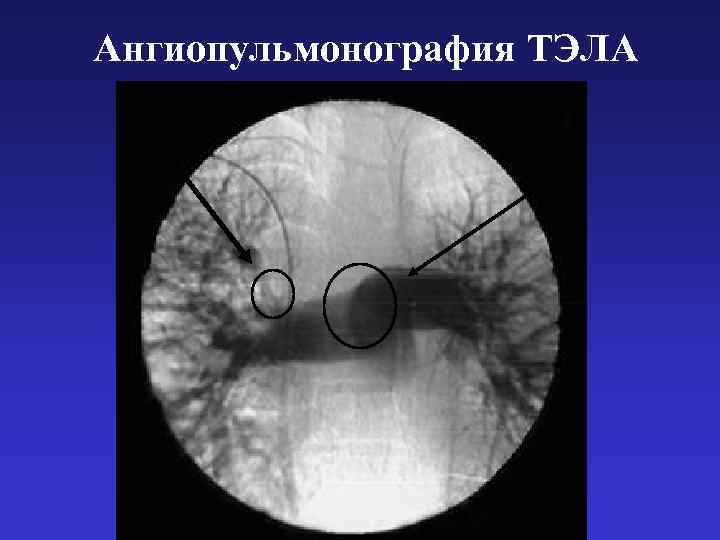 Ангиопульмонография ТЭЛА 