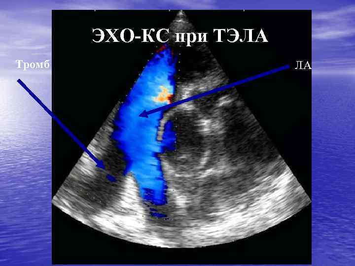 ЭХО-КС при ТЭЛА Тромб ЛА 