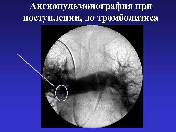 Ангиопульмонография при поступлении, до тромболизиса 