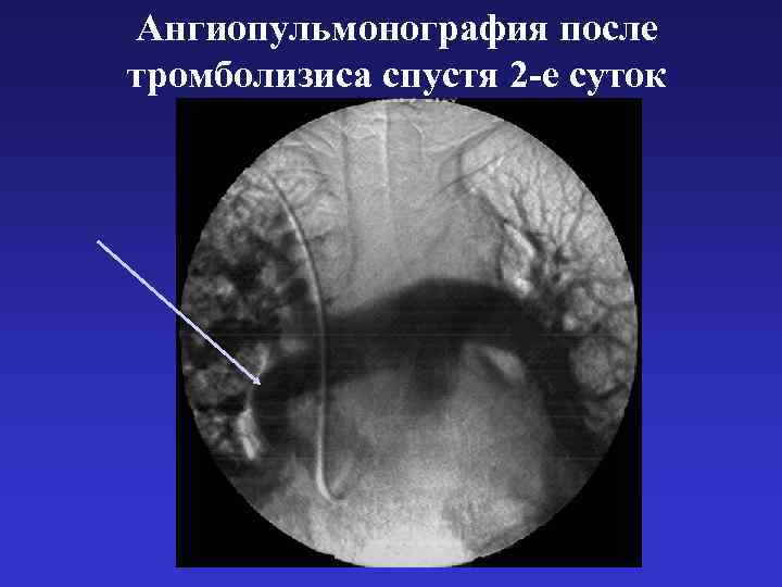 Ангиопульмонография после тромболизиса спустя 2 -е суток 