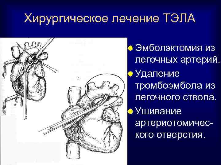 Операция тромбоэмболии легочной артерии. Операция тромбэктомия легочной артерии. Катетерная эмболэктомия при Тэла. Хирургическое лечение Тэла. Хирургическая тромбэктомия при Тэла.