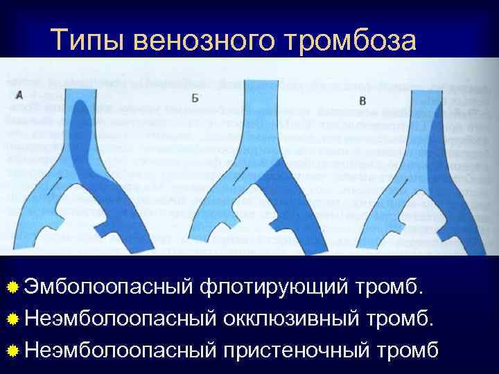 Типы венозного тромбоза ® Эмболоопасный флотирующий тромб. ® Неэмболоопасный окклюзивный тромб. ® Неэмболоопасный пристеночный