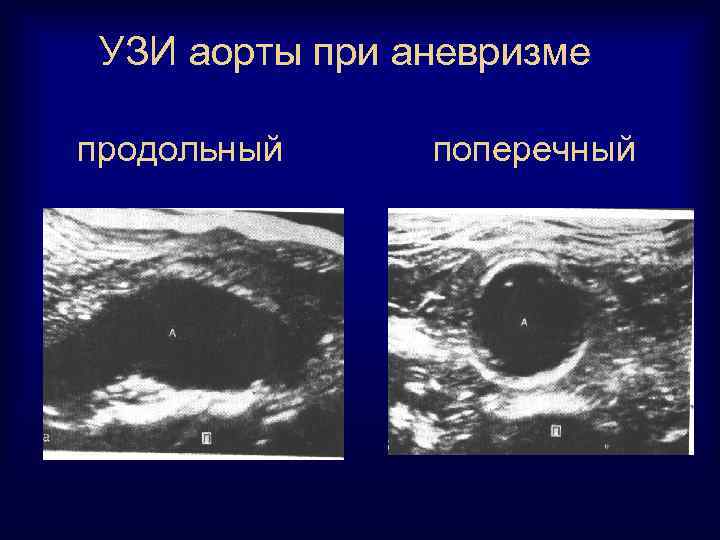 УЗИ аорты при аневризме продольный поперечный 