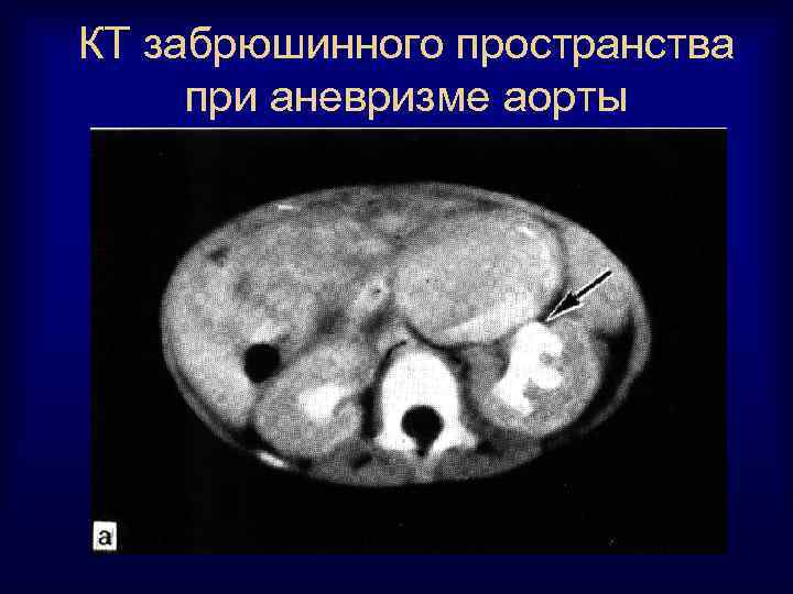 КТ забрюшинного пространства при аневризме аорты 