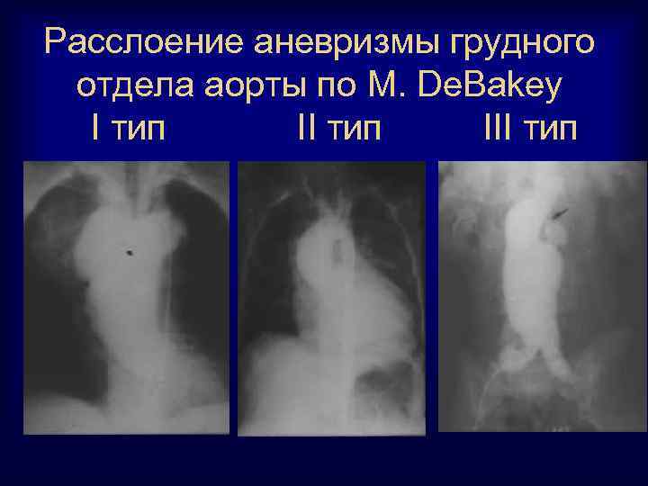 Расслоение аневризмы грудного отдела аорты по M. De. Bakey I тип III тип 