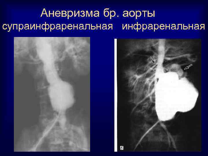 Аневризма бр. аорты супраинфраренальная 