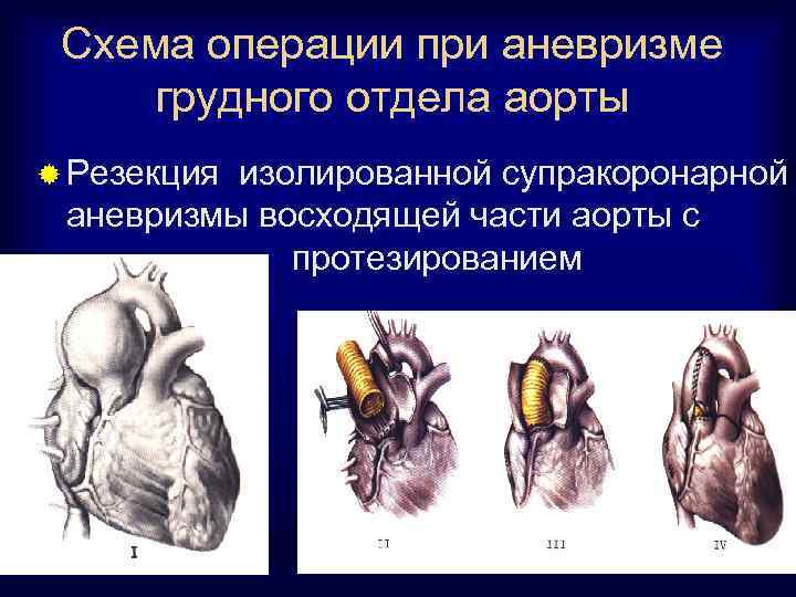 Схема операции при аневризме грудного отдела аорты ® Резекция изолированной супракоронарной аневризмы восходящей части