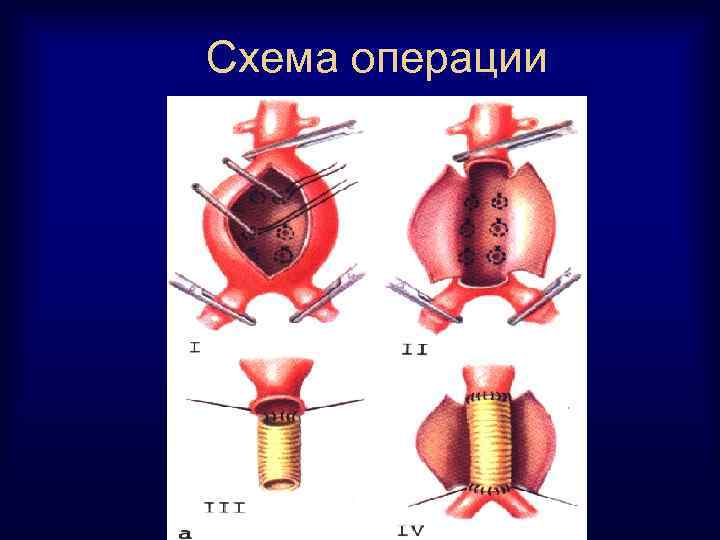 Схема операции 