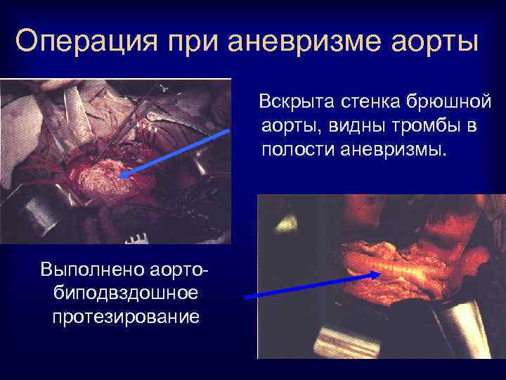 Операция при аневризме аорты Вскрыта стенка брюшной аорты, видны тромбы в полости аневризмы. Выполнено