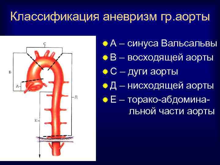 Классификация аневризм гр. аорты ®А – синуса Вальсальвы ® В – восходящей аорты ®