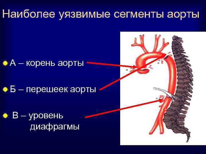 Наиболее уязвимые сегменты аорты ®А – корень аорты ®Б – перешеек аорты ® В