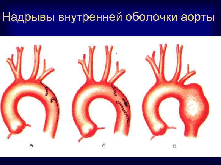 Надрывы внутренней оболочки аорты 