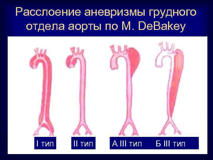 Расслоение аневризмы грудного отдела аорты по M. De. Bakey I тип II тип А