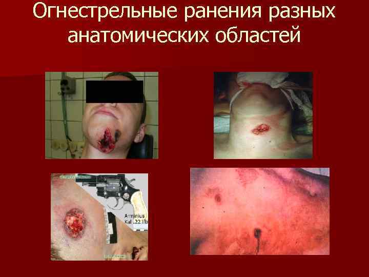 Огнестрельные ранения разных анатомических областей 