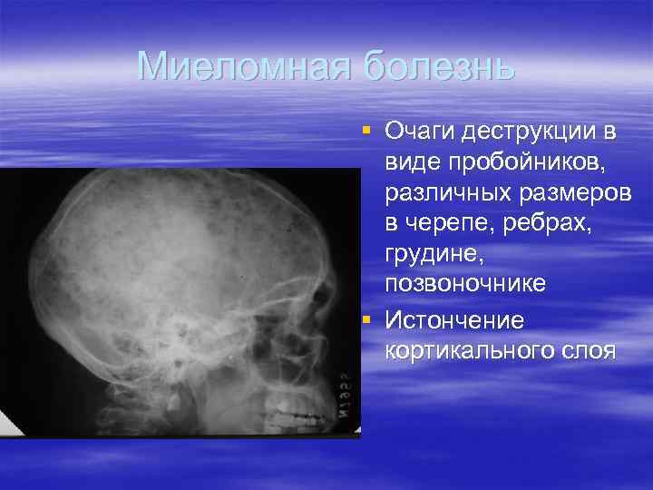 Множественные округлые. Миеломная болезнь рентген черепа. Миеломная болезнь костей черепа. Миеломная болезнь висцеральная форма. Миеломная болезнь кости.