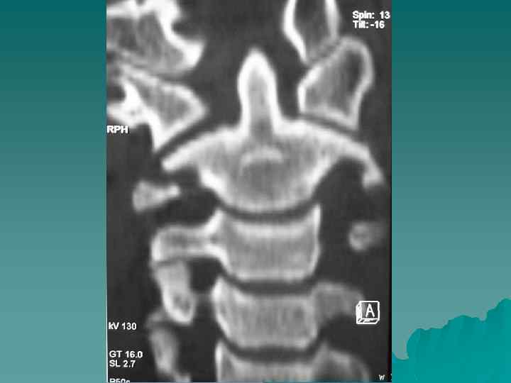 Рентгеноанатомия поясничного отдела позвоночника