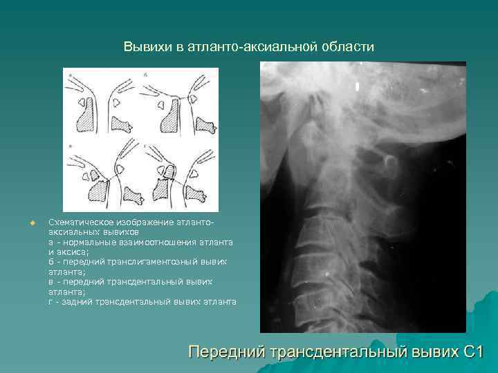 Вывихи в атланто-аксиальной области u Схематическое изображение атлантоаксиальных вывихов а - нормальные взаимоотношения атланта