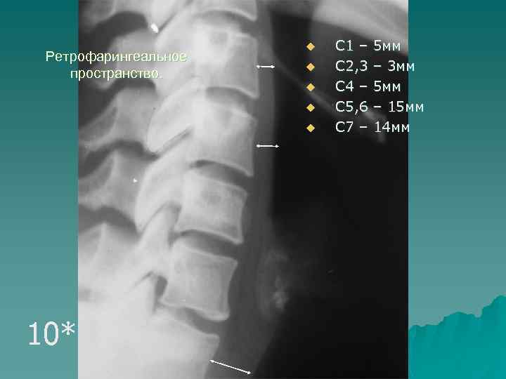 Ретрофарингеальное пространство. u u u 10* С 1 – 5 мм С 2, 3