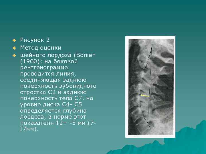 u u u Рисунок 2. Метод оценки шейного лордоза (Вопiеп (1960): на боковой рентгенограмме