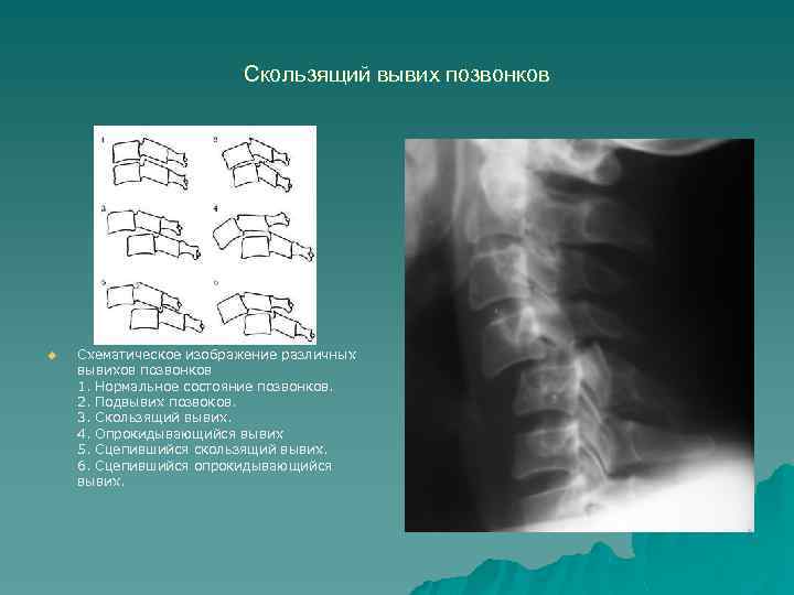 Скользящий вывих позвонков u Схематическое изображение различных вывихов позвонков 1. Нормальное состояние позвонков. 2.