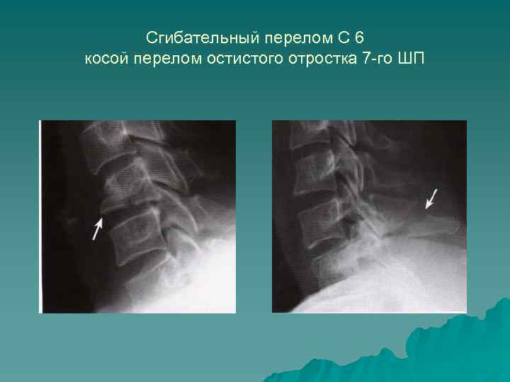 Сгибательный перелом С 6 косой перелом остистого отростка 7 -го ШП 