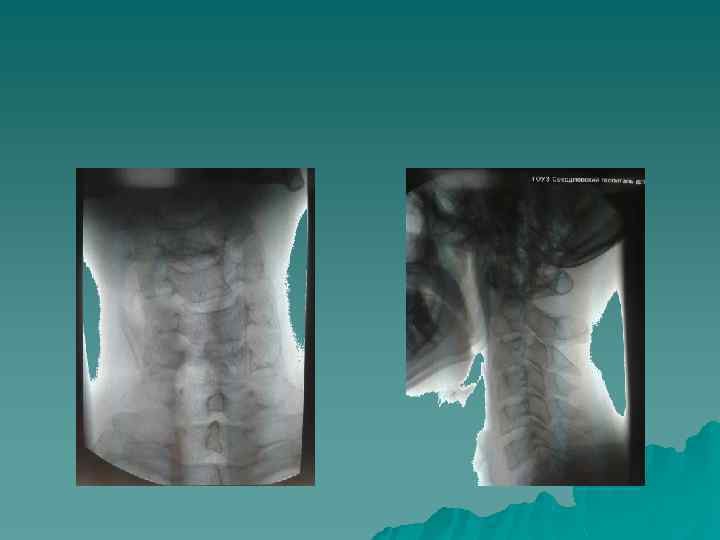 Рентгеноанатомия поясничного отдела позвоночника