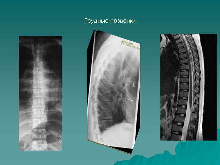 Грудные позвонки 