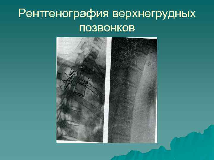 Рентгенография верхнегрудных позвонков 