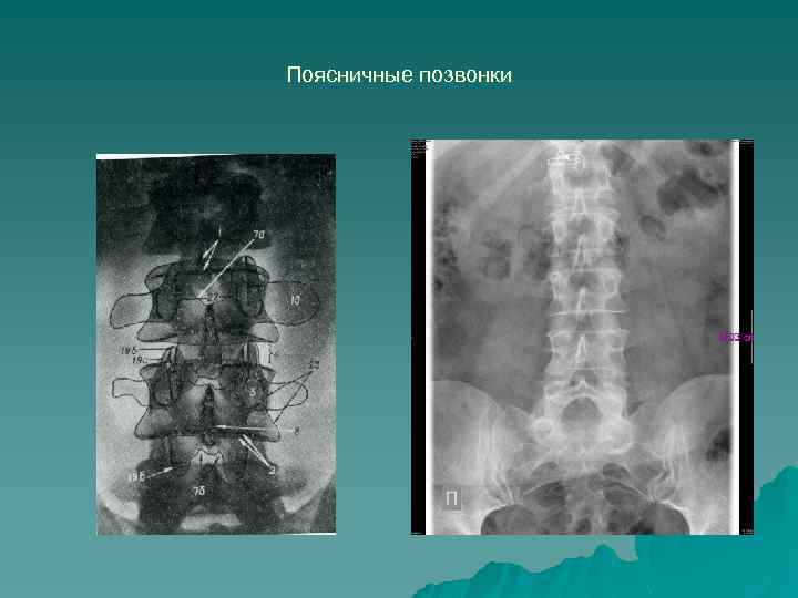 Поясничные позвонки 