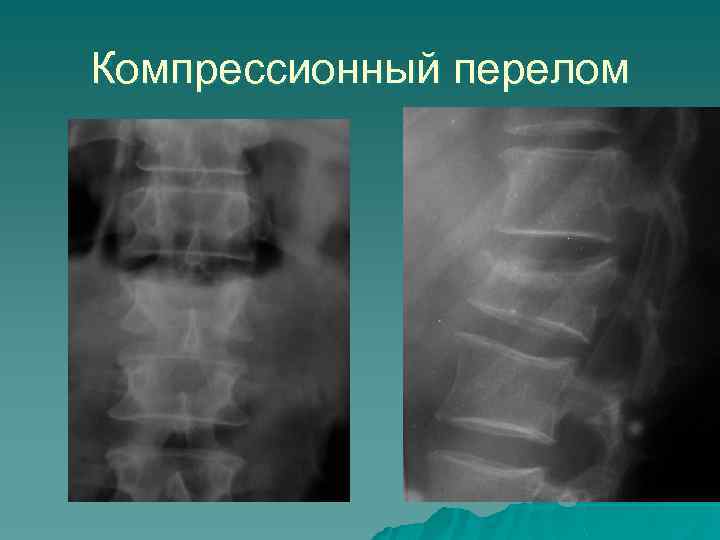 Признаки компрессионного перелома позвоночника. Компрессионный перелом позвоночника рентген. Сгибательный перелом позвонка рентген. Компрессионный перелом позвонка рентген. Перелом позвонка грудного отдела рентген.