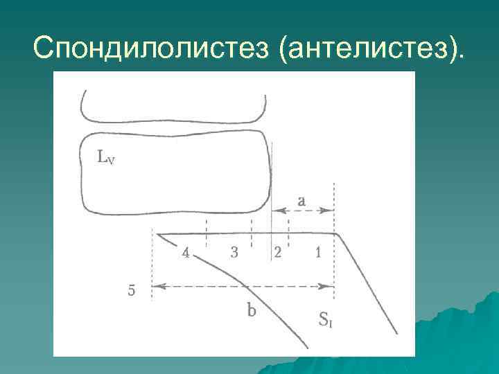 Спондилолистез (антелистез). 